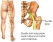 Siyatik Bacak Ağrısı Belirtileri ve Tedavisi