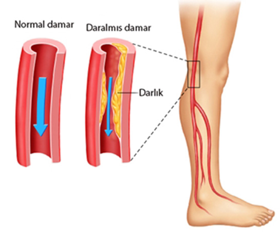 Bacak Damar Tkankl